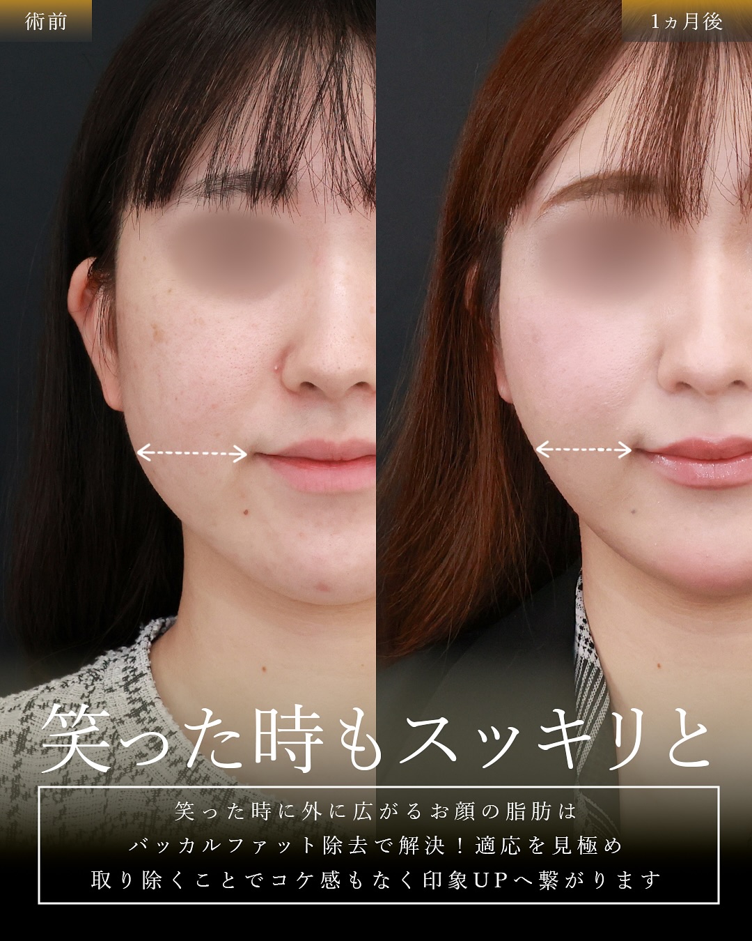 TAC式 ツヤ肌コラーゲンリフト®/バッカルファット除去/ジョールファット除去の症例写真 施術前後 