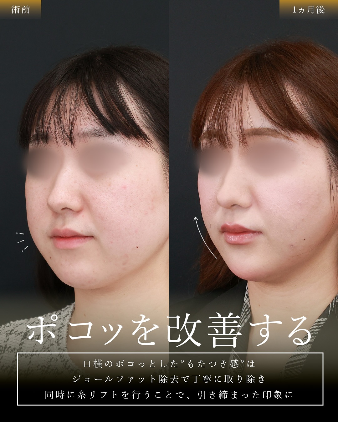 TAC式 ツヤ肌コラーゲンリフト®/バッカルファット除去/ジョールファット除去の症例写真 施術前後 