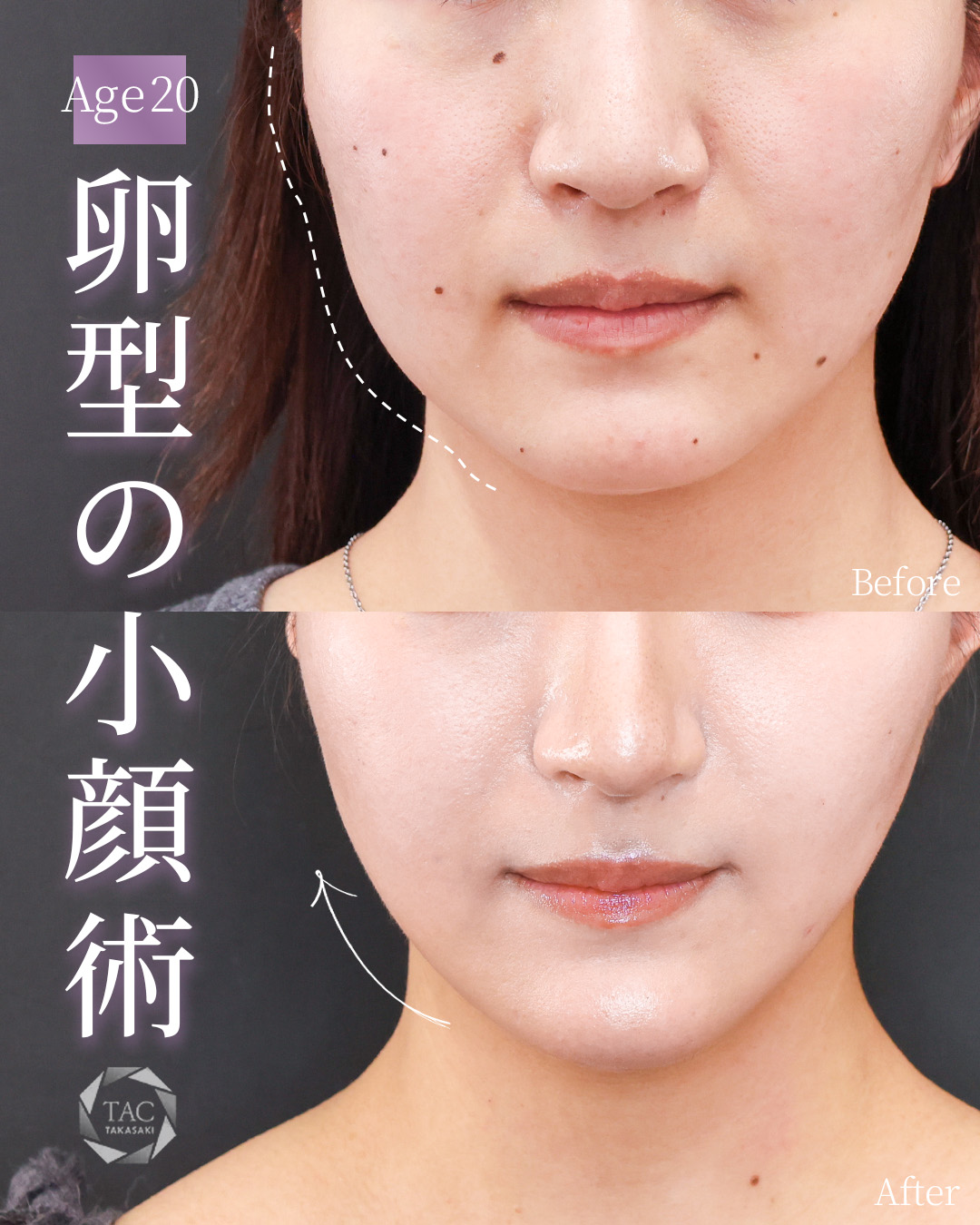 TAC式 ツヤ肌コラーゲンリフト®/顎下の脂肪吸引・顔の脂肪吸引/Lラインファット除去（エラ下脂肪除去）の症例写真 施術前後 