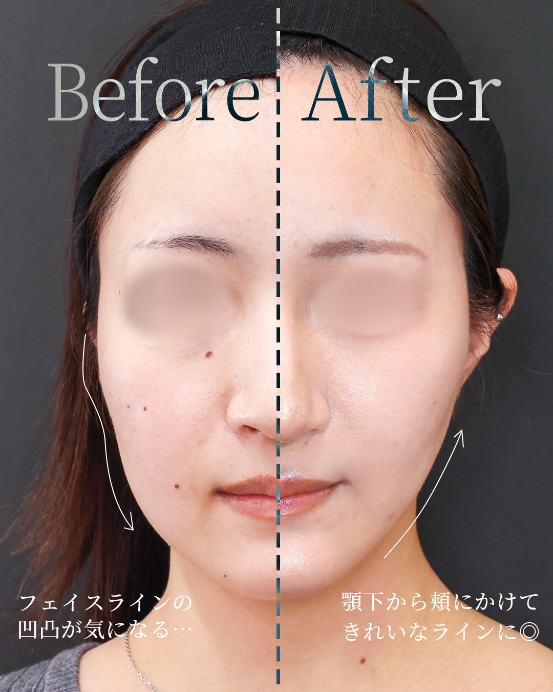 TAC式 ツヤ肌コラーゲンリフト®/顎下の脂肪吸引・顔の脂肪吸引/Lラインファット除去（エラ下脂肪除去）の症例写真 施術前後 