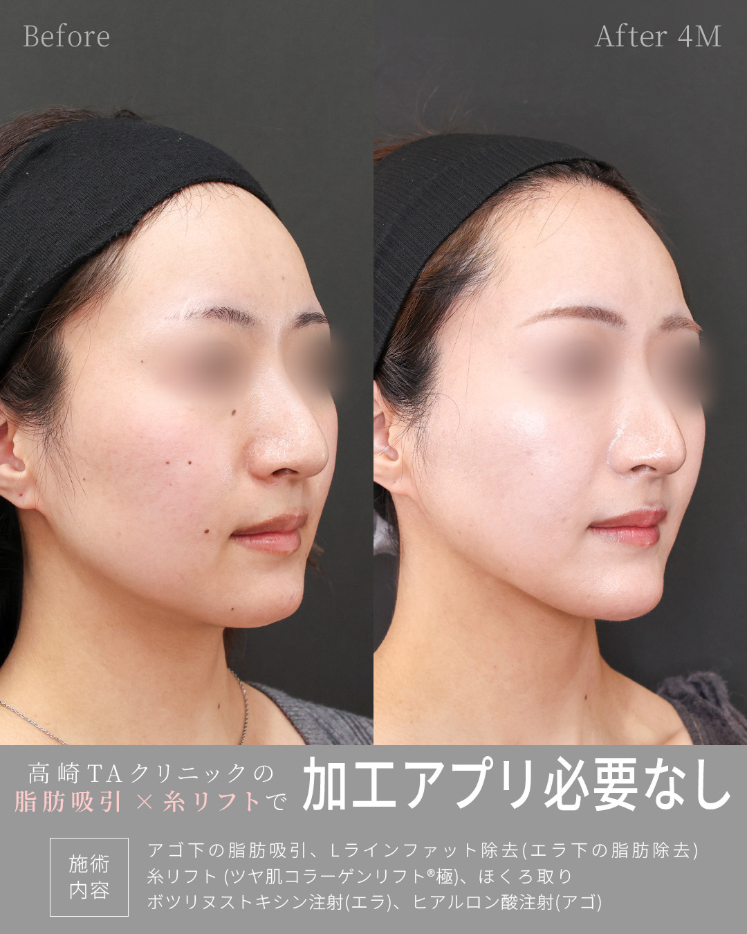 TAC式 ツヤ肌コラーゲンリフト®/顎下の脂肪吸引・顔の脂肪吸引/Lラインファット除去（エラ下脂肪除去）の症例写真 施術前後 