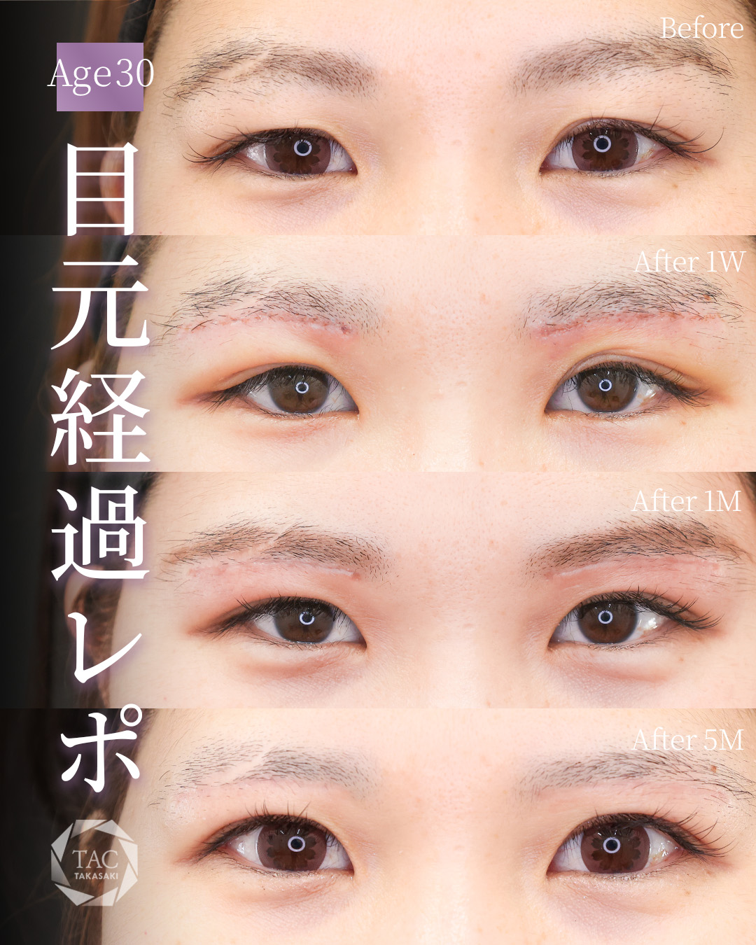 二重埋没法/眉毛下切開術の症例写真 施術前後 