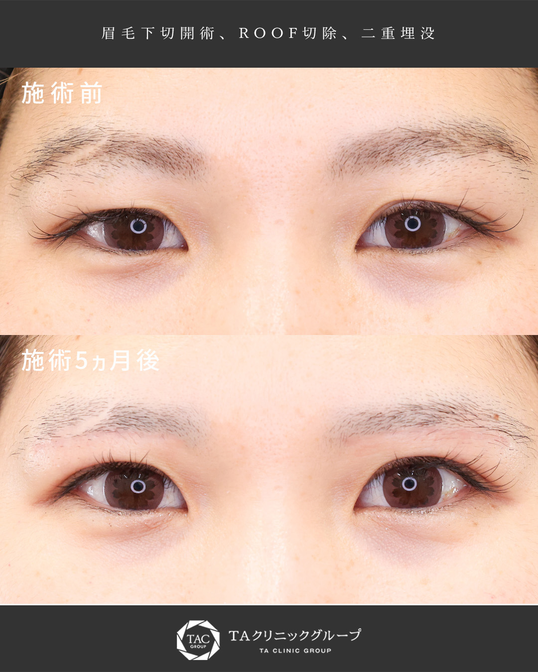 【30代の重ためまぶたが劇的チェンジ】二重埋没×眉下切開×ROOF切除