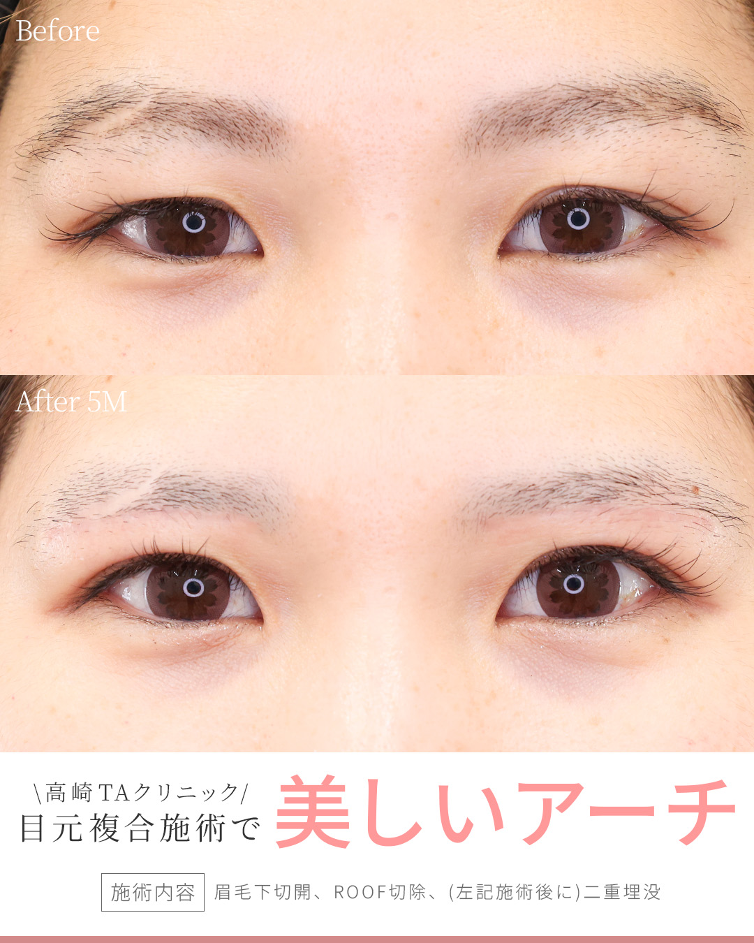 二重埋没法/眉毛下切開術の症例写真 施術前後 