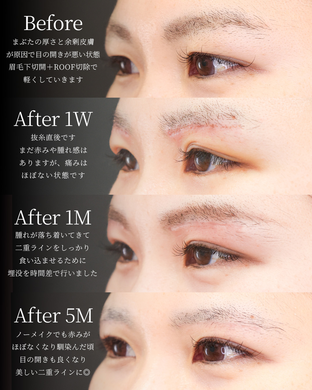 二重埋没法/眉毛下切開術の症例写真 施術前後 