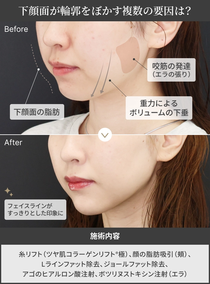 下顔面が輪郭をぼかす複数の要因は？