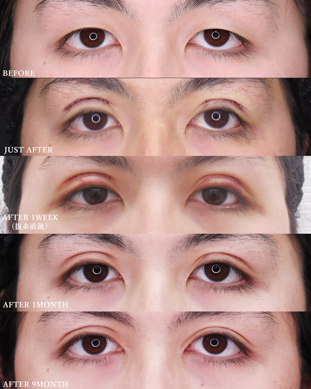 二重切開（全切開法）/目頭切開術の症例写真 施術前後 