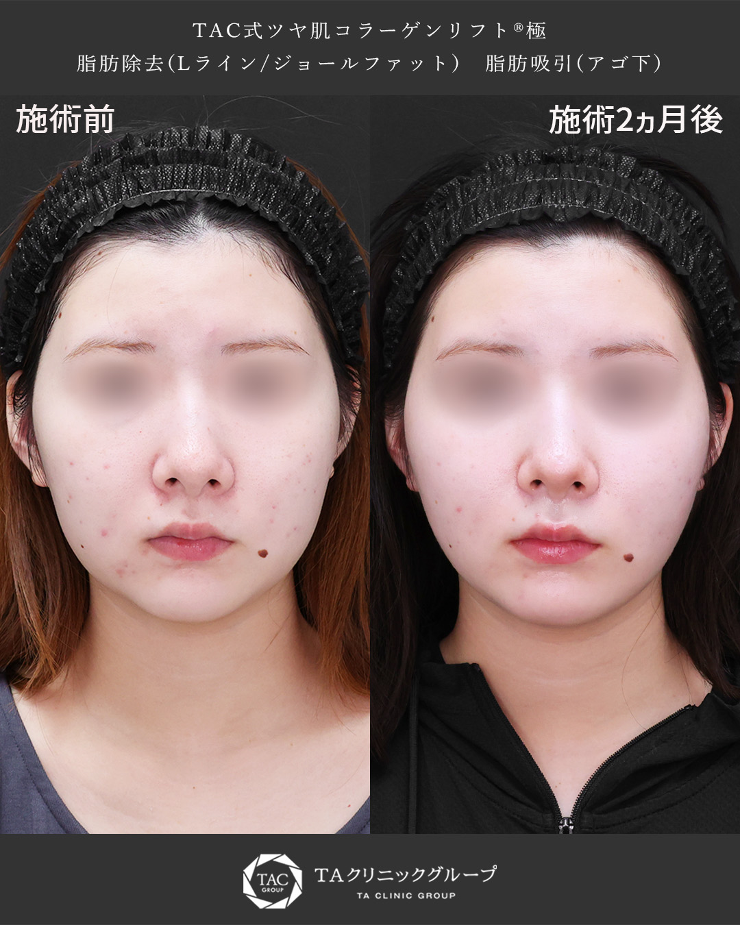 必要な脂肪は残し、卵型の輪郭に近づける