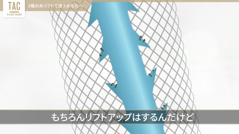ショッピングリフトの細い糸を示す模式図