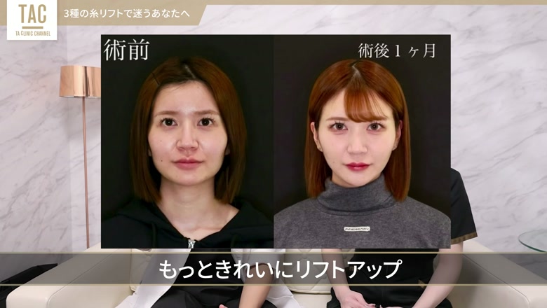糸リフトのビフォーアフター比較画面