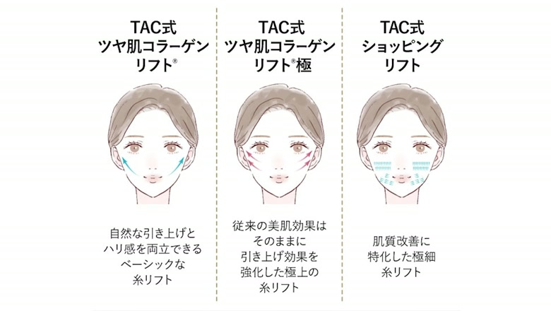 3種類の糸リフトを比較するまとめ画面