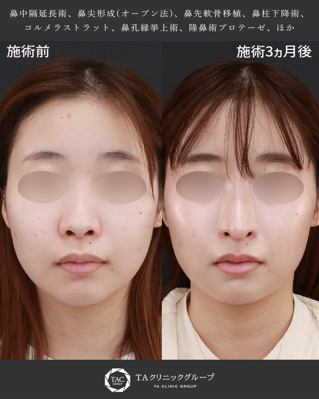 20代女性│鼻フル整形で理想のバランスに