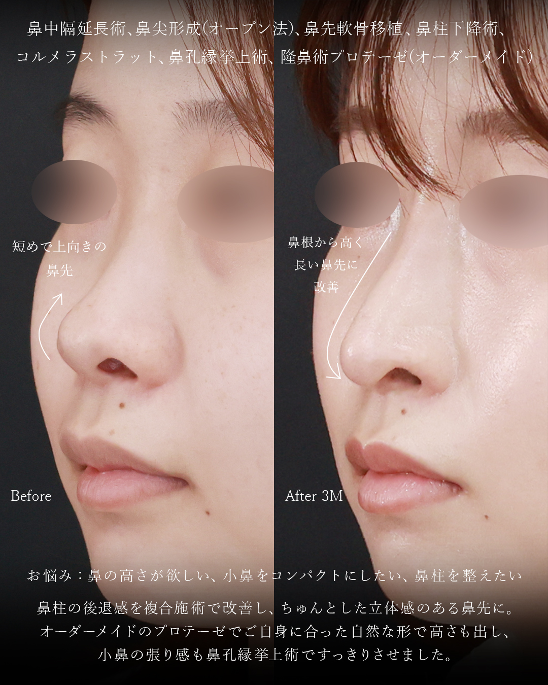 隆鼻術（プロテーゼ・自家組織）/鼻中隔延長術/鼻孔縁挙上術の症例写真 施術前後 