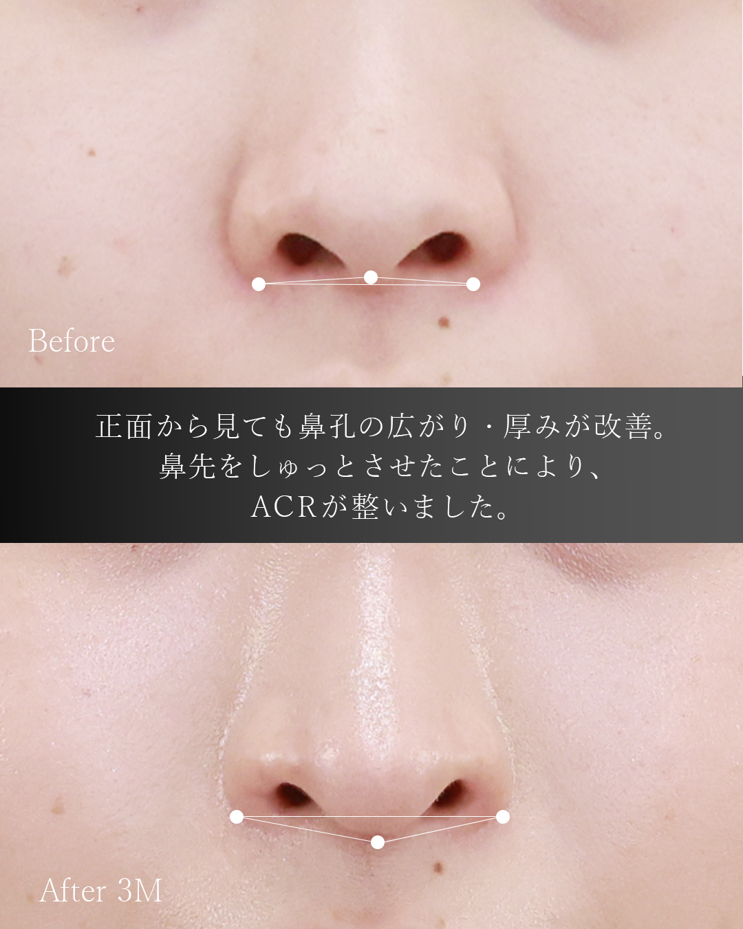 隆鼻術（プロテーゼ・自家組織）/鼻中隔延長術/鼻孔縁挙上術の症例写真 施術前後 