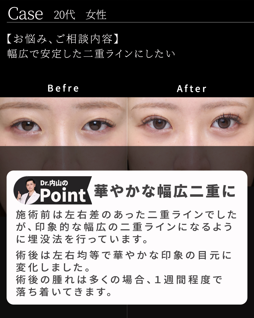 二重埋没法の症例写真 施術前後 