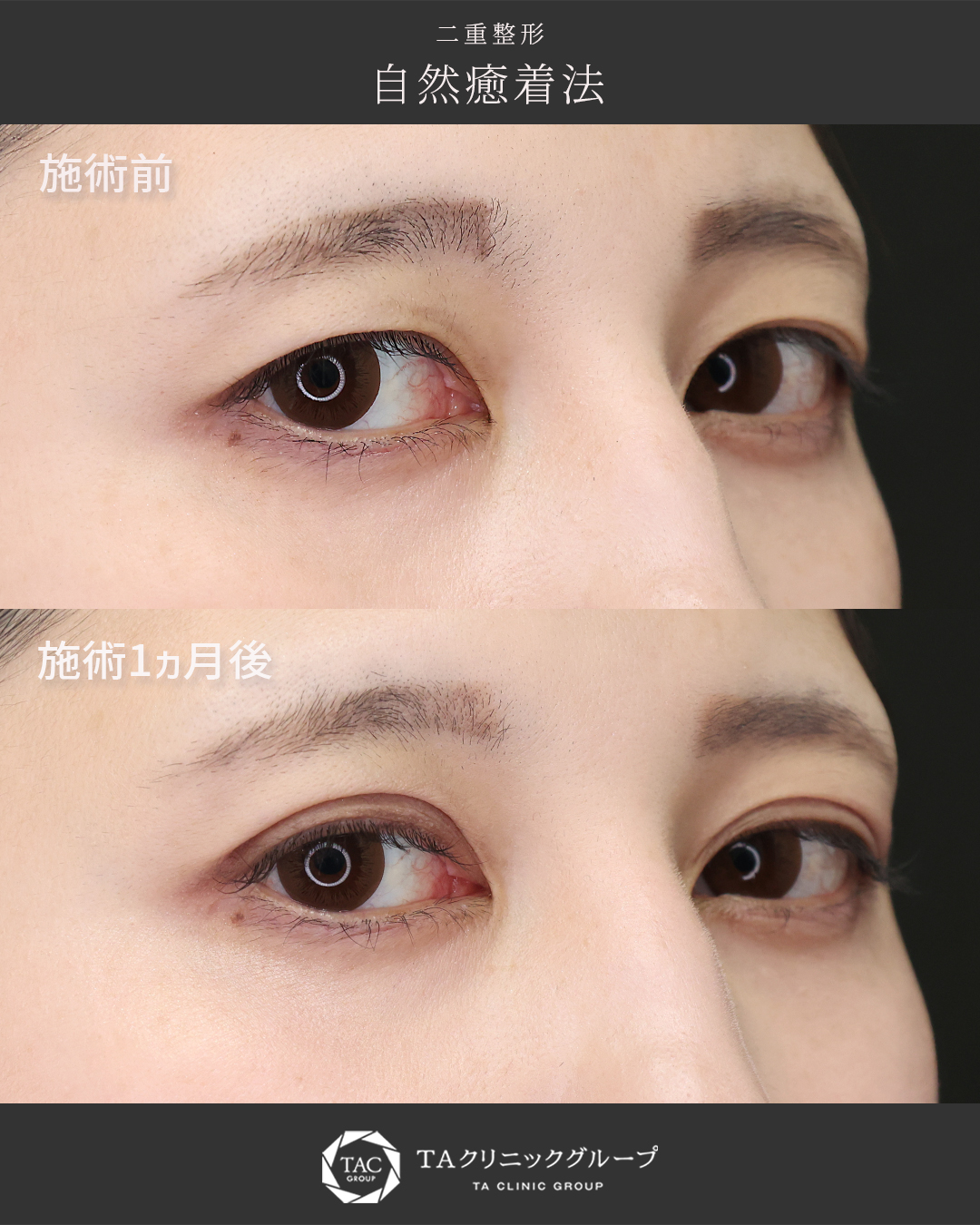 【自然癒着法】で長持ちくっきり二重へ