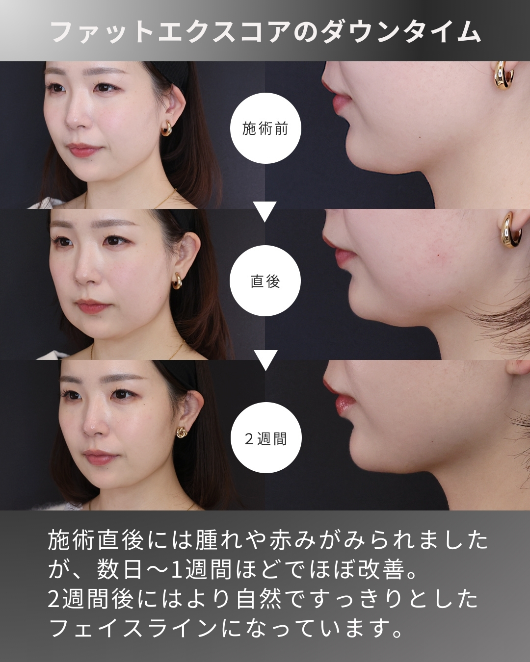 脂肪溶解注射の症例写真 施術前後 