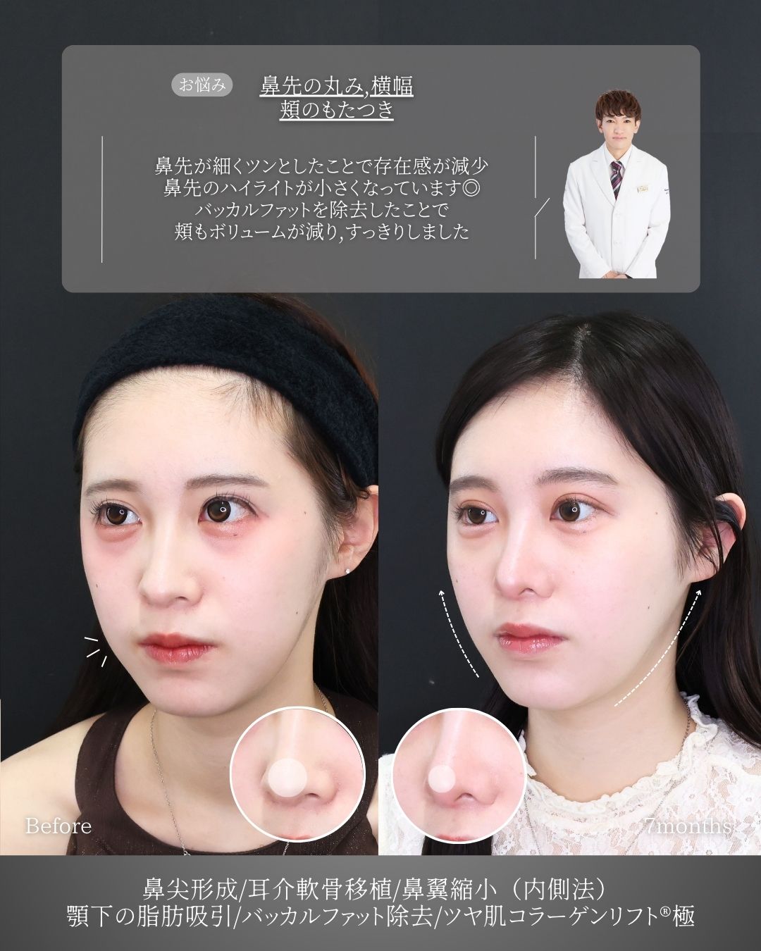 鼻尖形成・鼻尖縮小/鼻先軟骨移植/TAC式 鼻翼縮小術（小鼻縮小）の症例写真 施術前後 