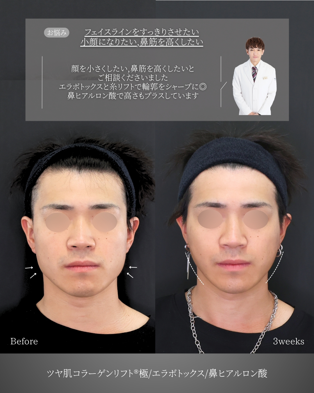 TAC式 ツヤ肌コラーゲンリフト®/エラボトックス注射/鼻のヒアルロン酸注射の症例写真 施術前後 