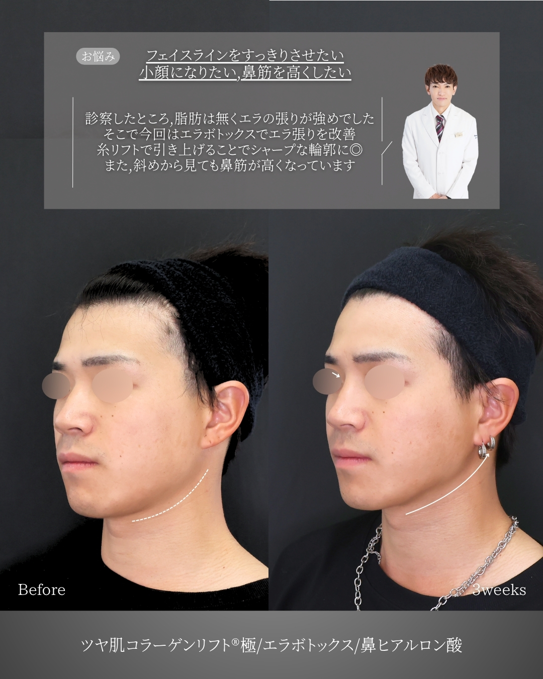 TAC式 ツヤ肌コラーゲンリフト®/エラボトックス注射/鼻のヒアルロン酸注射の症例写真 施術前後 