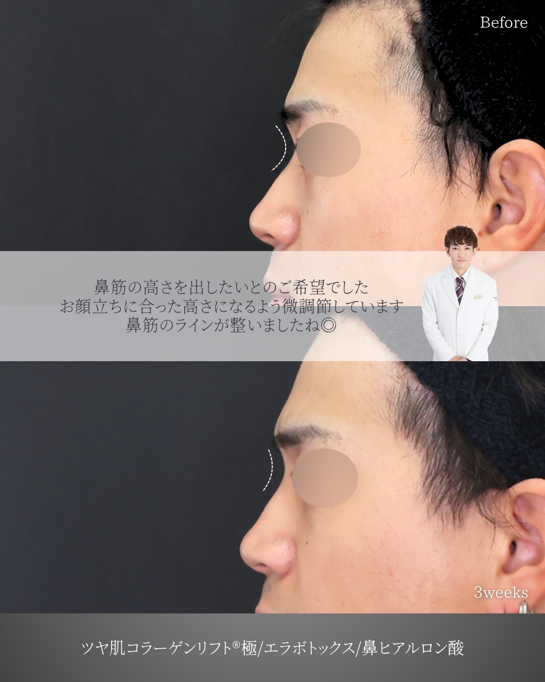 TAC式 ツヤ肌コラーゲンリフト®/エラボトックス注射/鼻のヒアルロン酸注射の症例写真 施術前後 