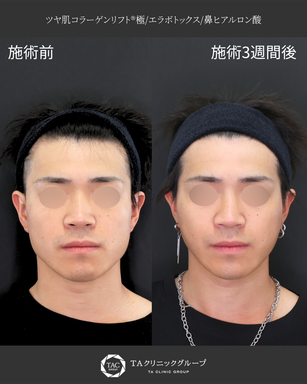 【糸リフト×エラボトックス】｜輪郭を整えるメンズ美容