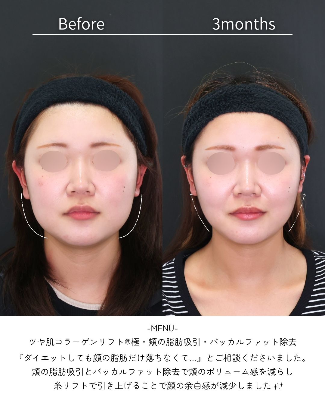 TAC式 ツヤ肌コラーゲンリフト®/バッカルファット除去/顎下の脂肪吸引・顔の脂肪吸引の症例写真 施術前後 