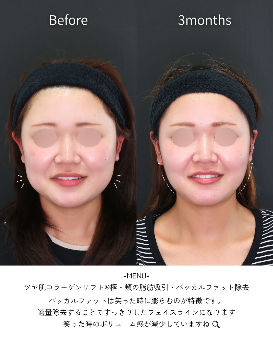 TAC式 ツヤ肌コラーゲンリフト®/バッカルファット除去/顎下の脂肪吸引・顔の脂肪吸引の症例写真 施術前後 