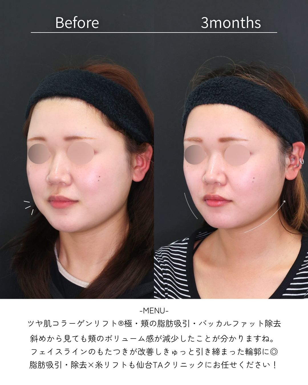 TAC式 ツヤ肌コラーゲンリフト®/バッカルファット除去/顎下の脂肪吸引・顔の脂肪吸引の症例写真 施術前後 