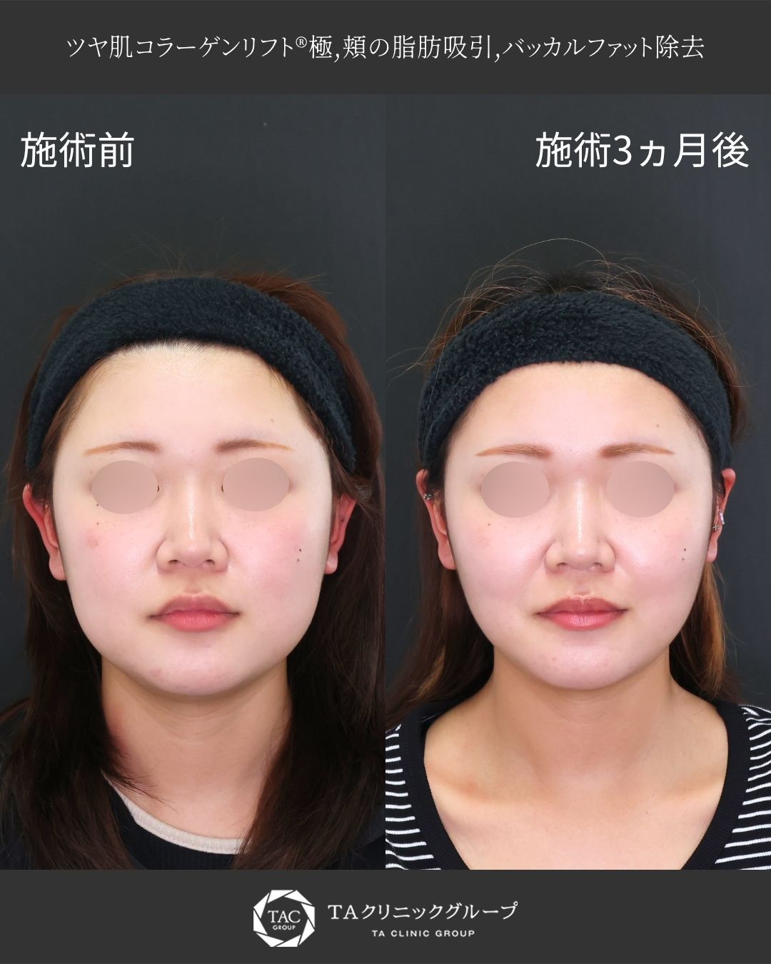 【糸リフト×脂肪除去】｜頬のボリューム感を減らして引き上げる