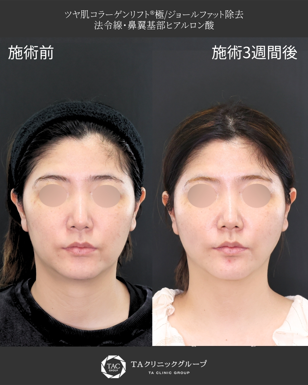 【糸リフト×脂肪除去】｜30代から始めるアンチエイジング