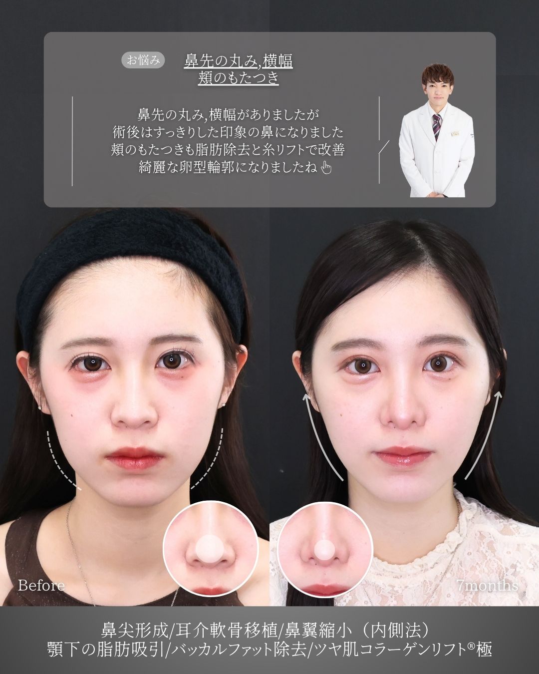 鼻尖形成・鼻尖縮小/鼻先軟骨移植/TAC式 鼻翼縮小術（小鼻縮小）の症例写真 施術前後 