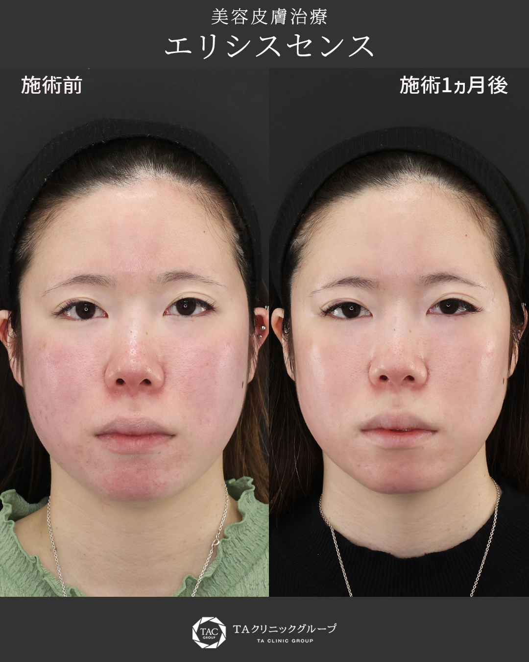 【エリシスセンス】毛穴・ニキビ跡・小じわ・くすみが気になる方へ