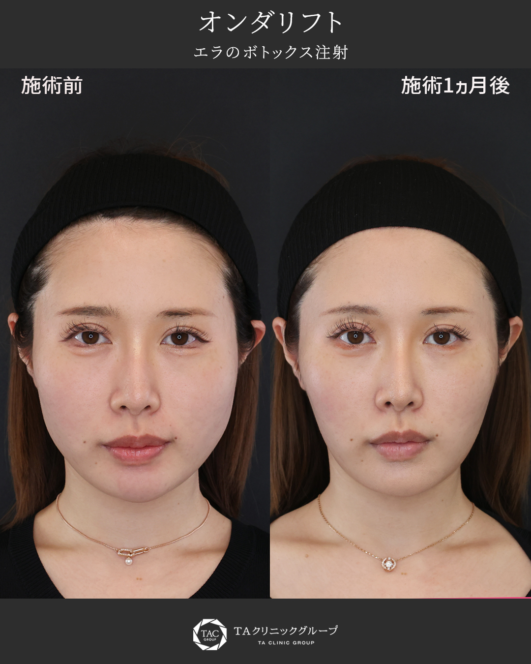 たるみを軽減し、輪郭を整える組み合わせ施術