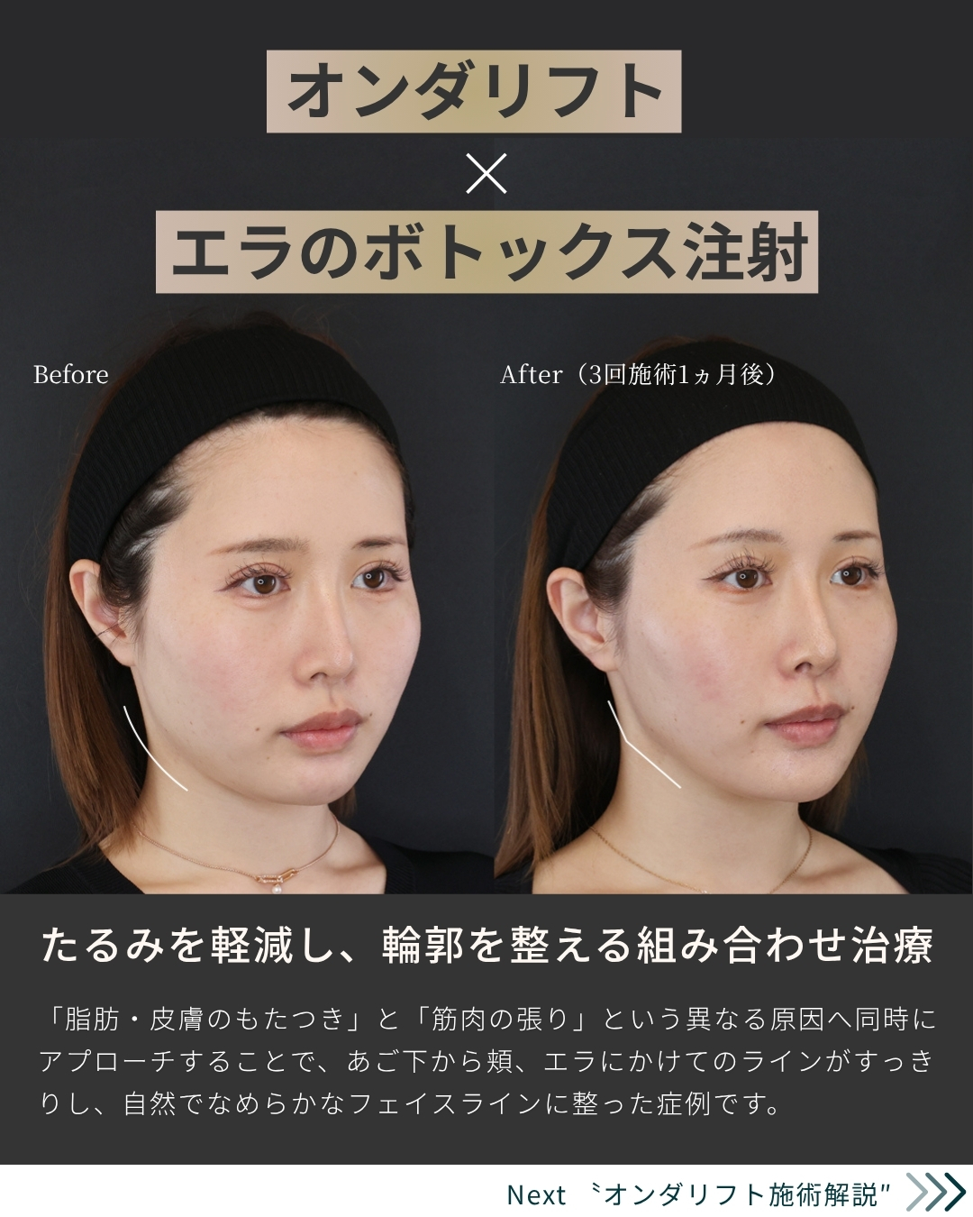 オンダリフト（オンダプロ）・オンダリフトボディ/エラボトックス注射の症例写真 施術前後 