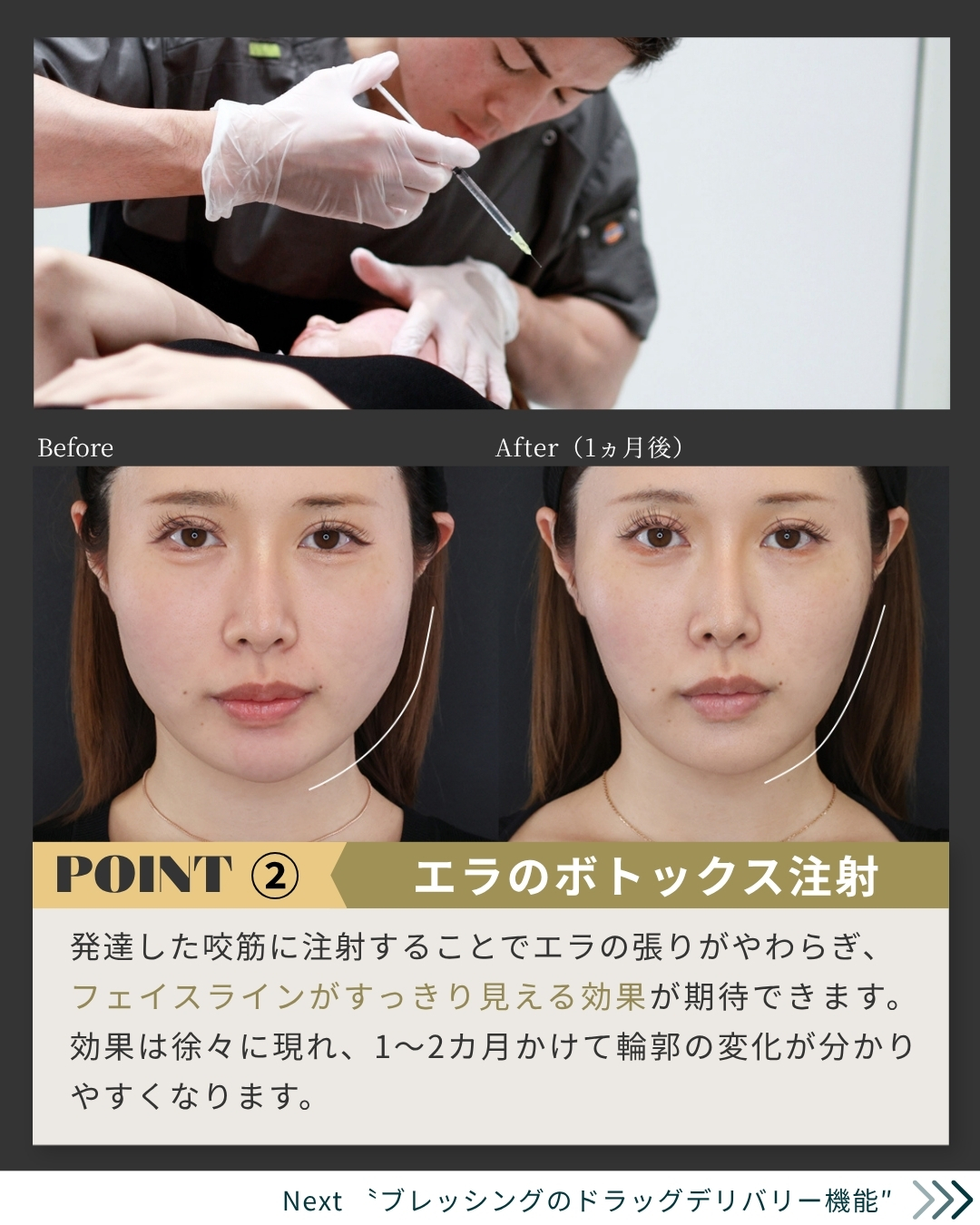 オンダリフト（オンダプロ）・オンダリフトボディ/エラボトックス注射の症例写真 施術前後 