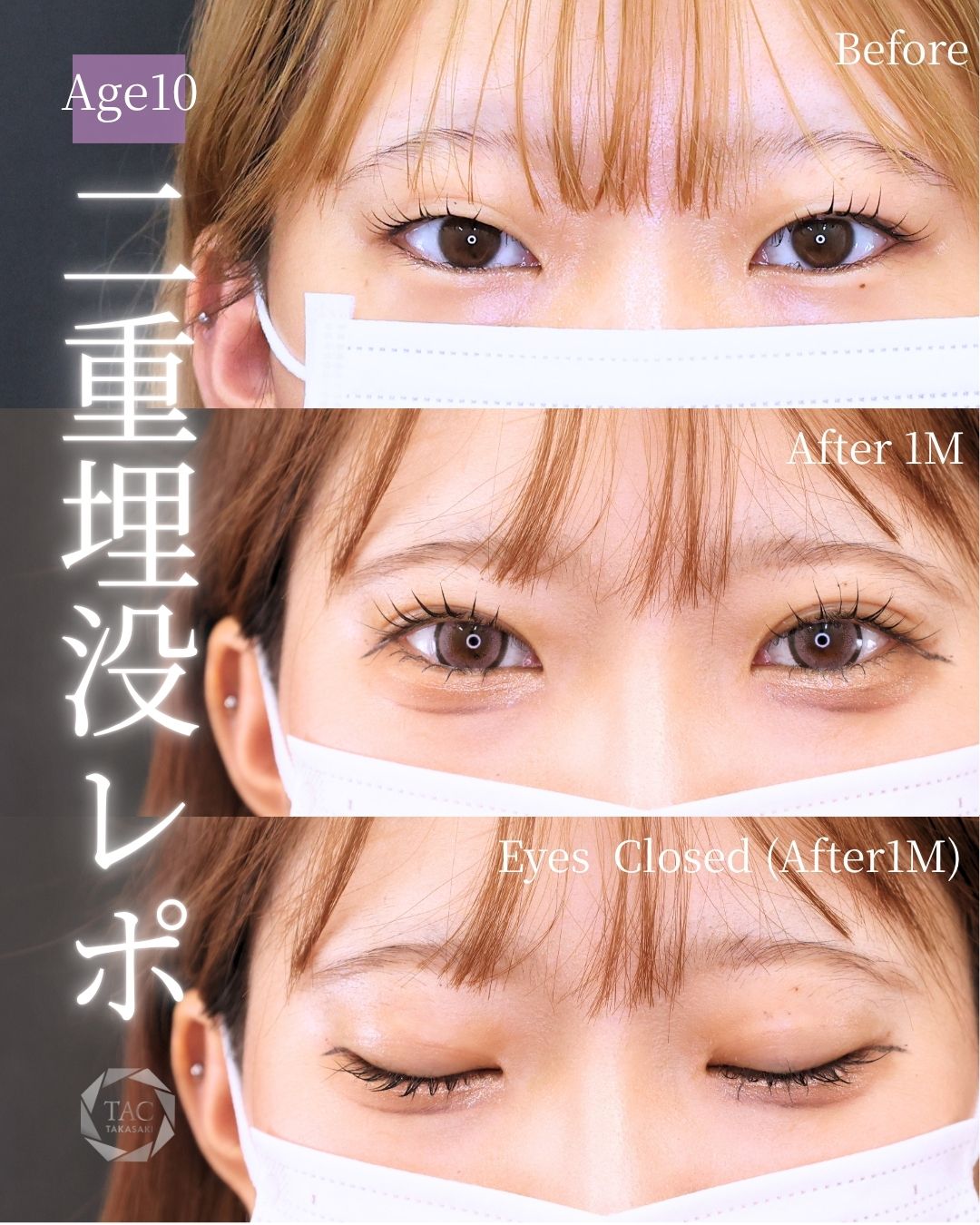 二重埋没法（切らない二重整形）/涙袋形成（ヒアルロン酸注射）の症例写真 施術前後 