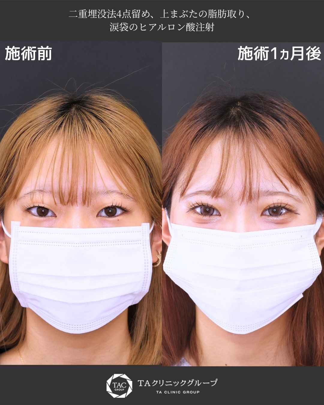 アイテープの卒業、【二重埋没法】で愛され二重へ