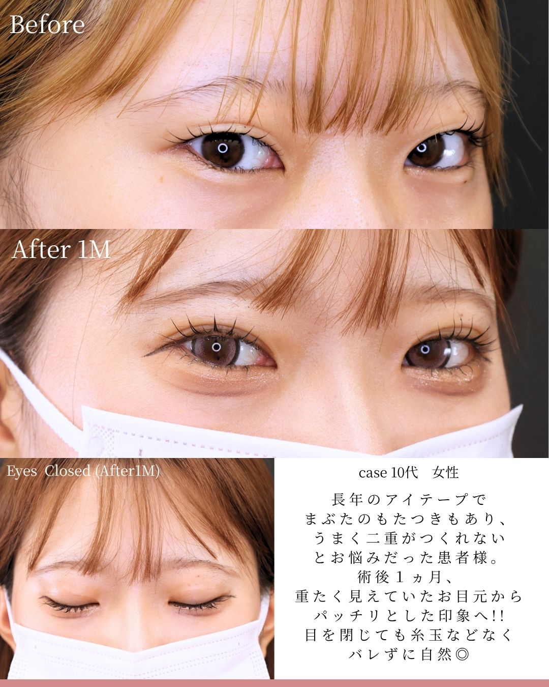 二重埋没法（切らない二重整形）/涙袋形成（ヒアルロン酸注射）の症例写真 施術前後 