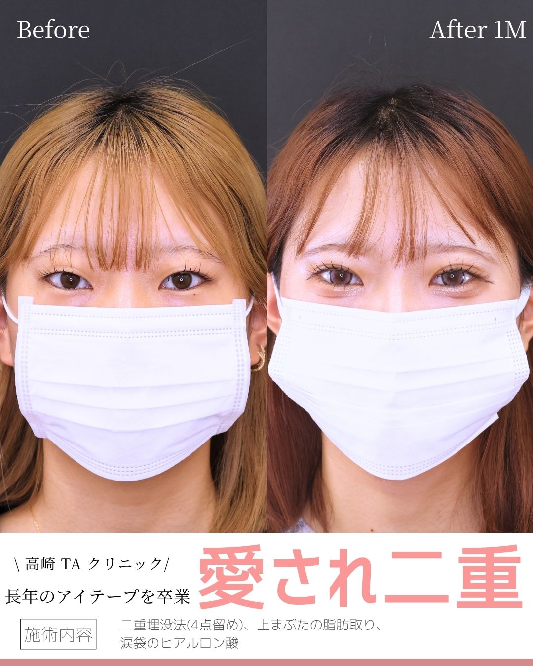 二重埋没法（切らない二重整形）/涙袋形成（ヒアルロン酸注射）の症例写真 施術前後 