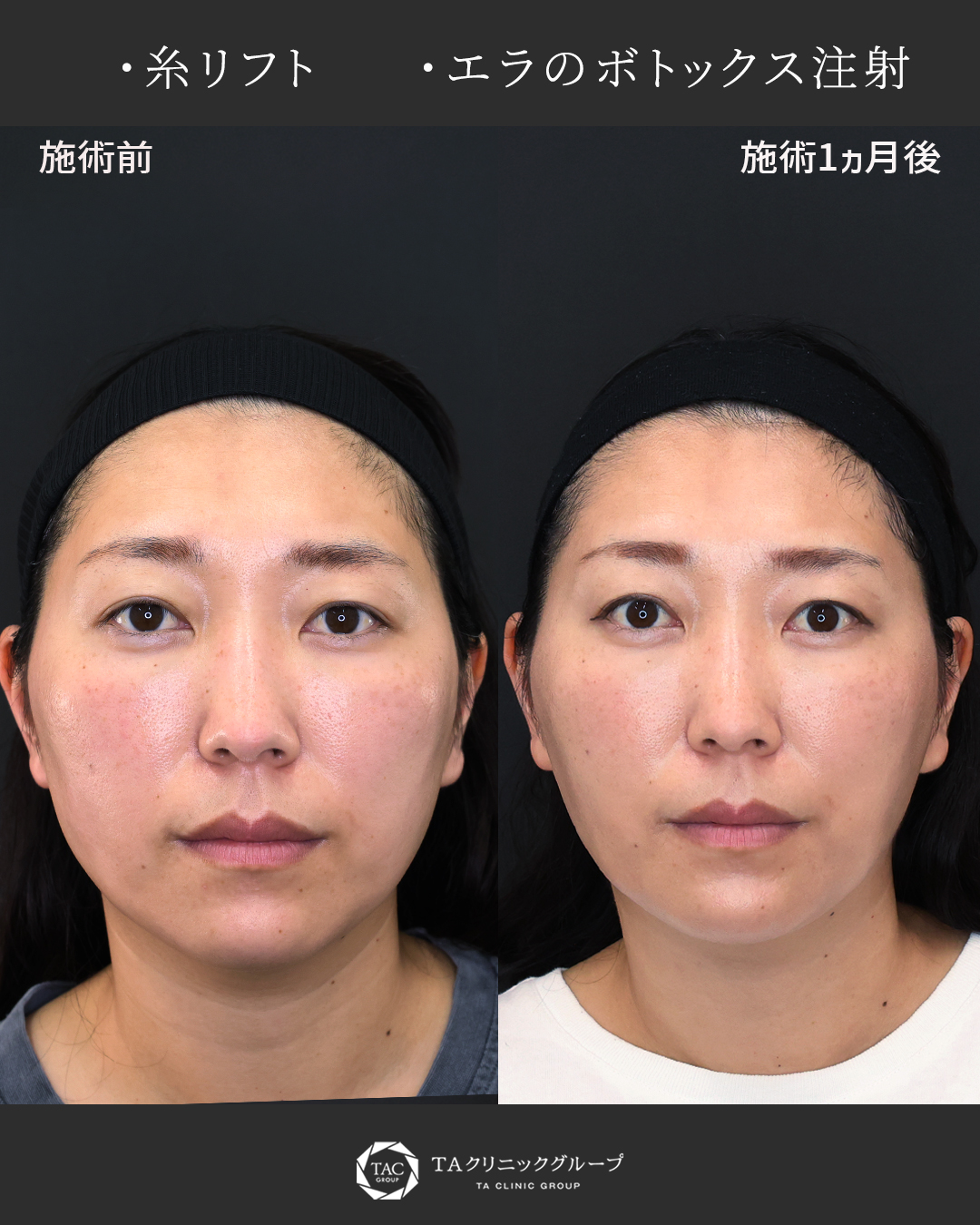 糸リフト×エラのボトックス注射　　たるんだ印象を変える小顔形成。　