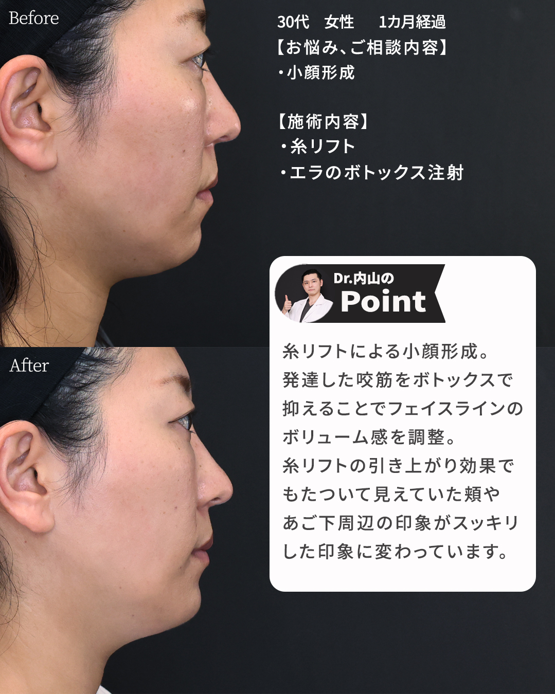 TAC式 ツヤ肌コラーゲンリフト®/エラボトックス注射の症例写真 施術前後 