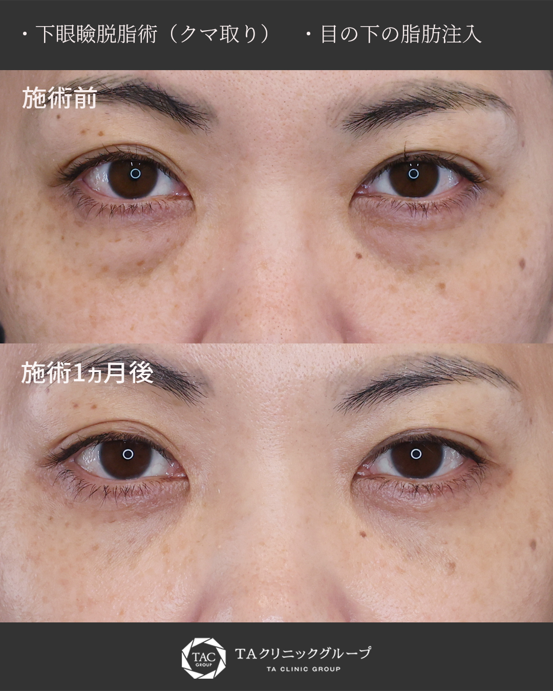 40代　セルフケアでは消えない　加齢による目の下の膨らみ