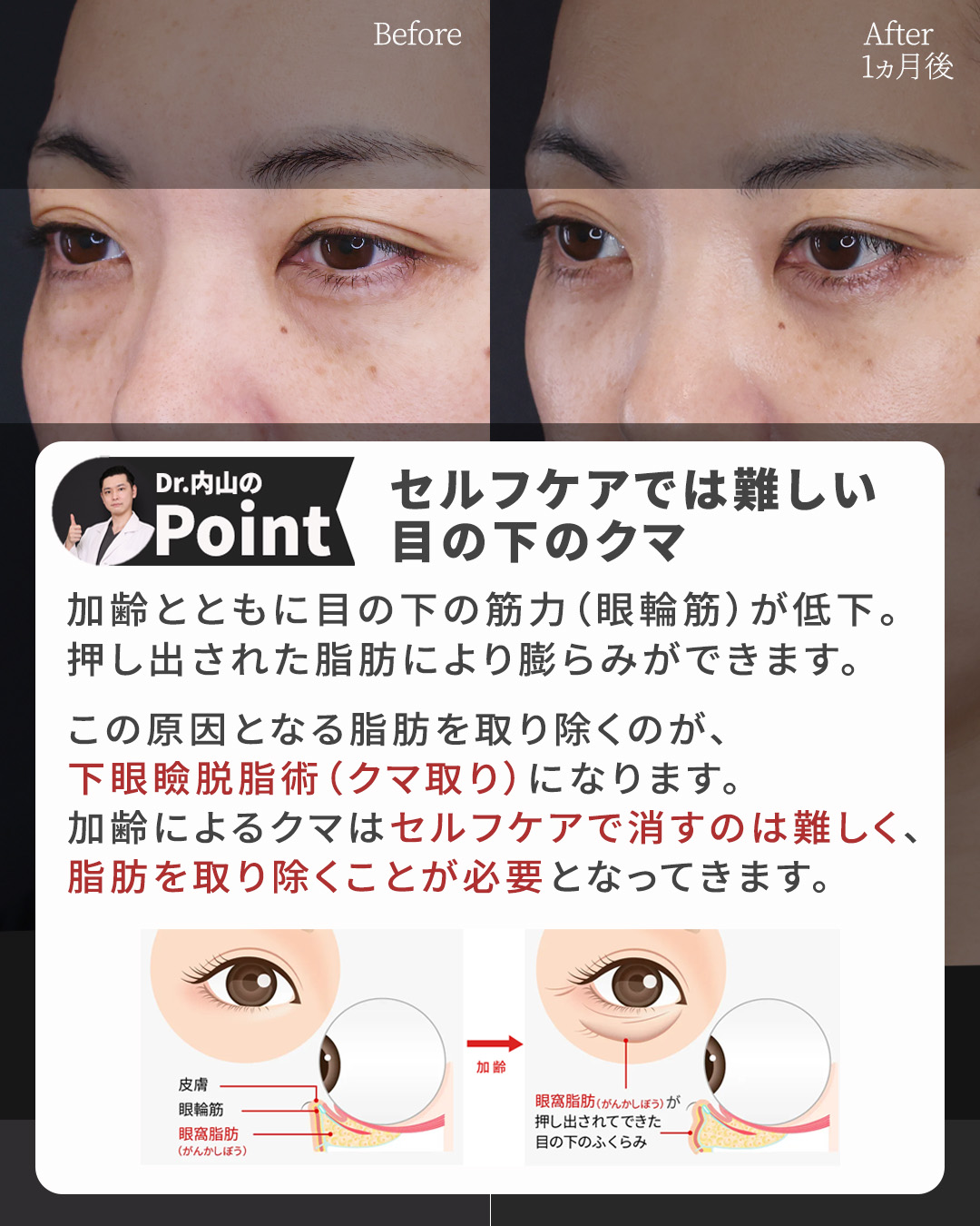 下眼瞼脱脂術（目の下のたるみ取り・目の下の脂肪ふくらみ取り）/顔の脂肪注入(コンデンスリッチフェイス)の症例写真 施術前後 