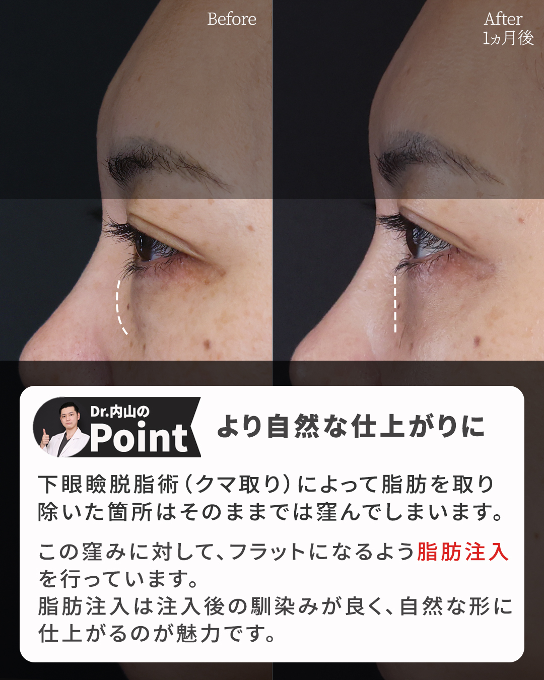 下眼瞼脱脂術（目の下のたるみ取り・目の下の脂肪ふくらみ取り）/顔の脂肪注入(コンデンスリッチフェイス)の症例写真 施術前後 