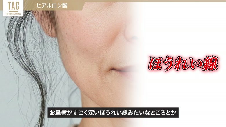 ヒアルロン酸注射の対象となるほうれい線