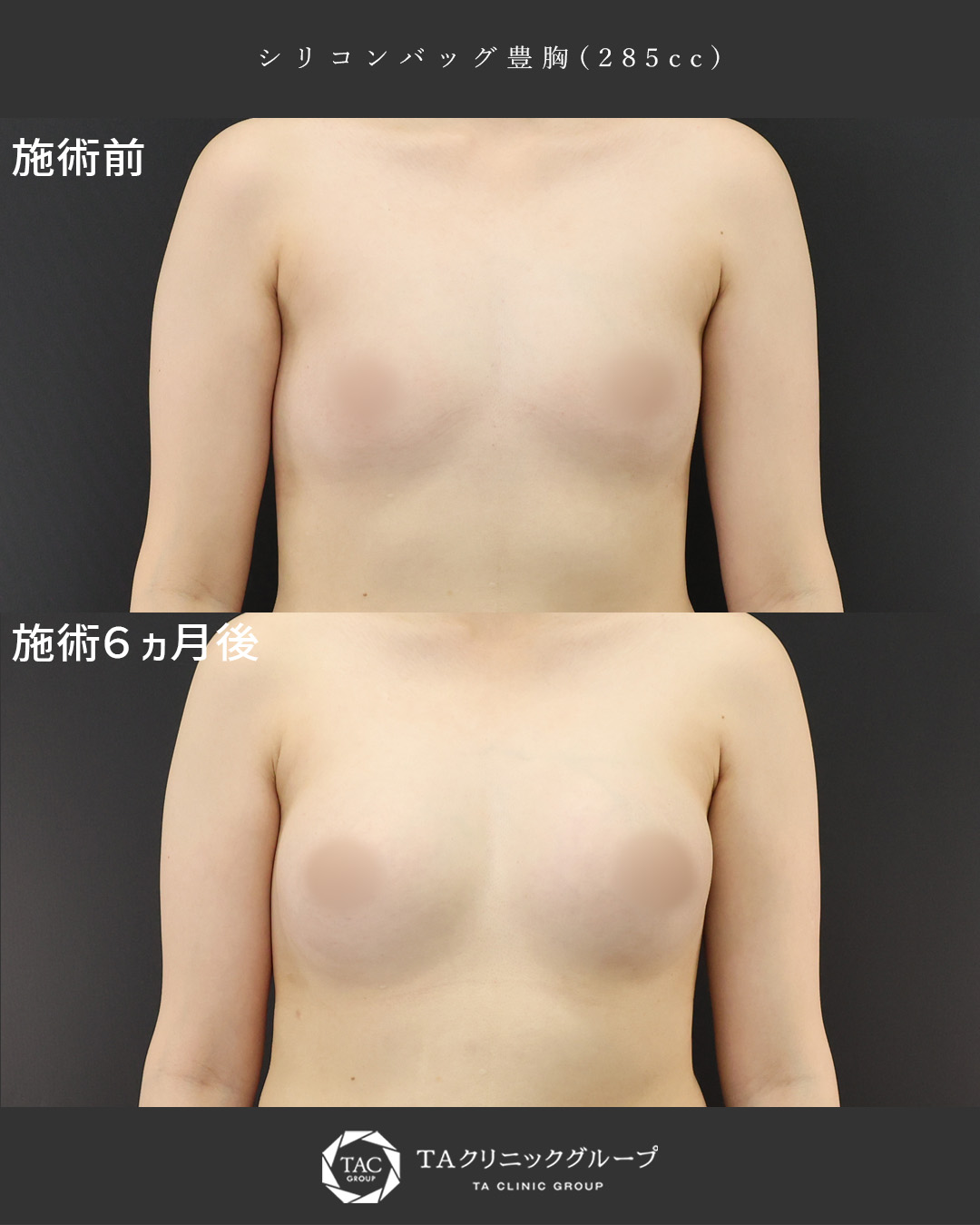 シリコンバッグ豊胸（人工乳腺バッグ）の症例写真 施術前後 