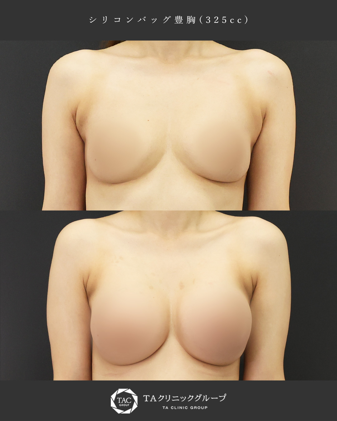 授乳後のボリュームダウンのお悩みに│30代豊胸