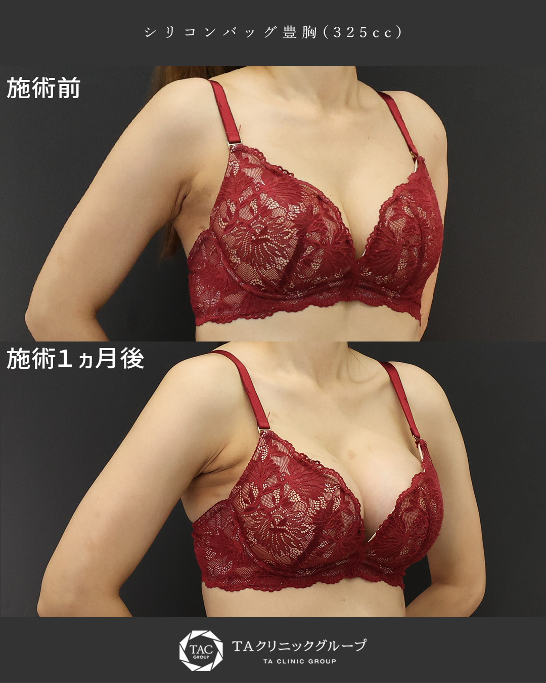 シリコンバッグ豊胸（人工乳腺バッグ）の症例写真 施術前後 