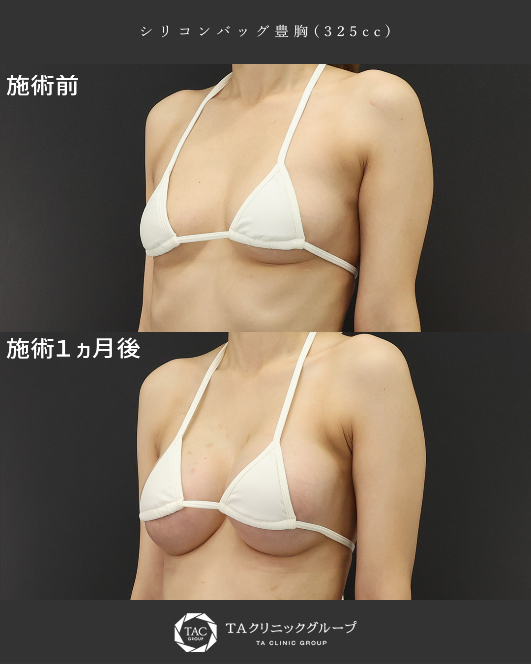 シリコンバッグ豊胸（人工乳腺バッグ）の症例写真 施術前後 